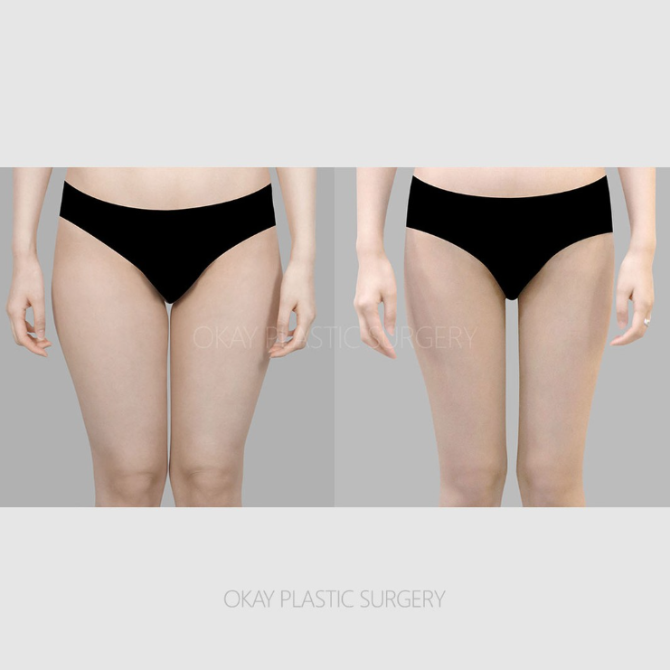 청담지방흡입, 운동해도 유독 안 빠지는 살의 정체는? 관련 이미지 6