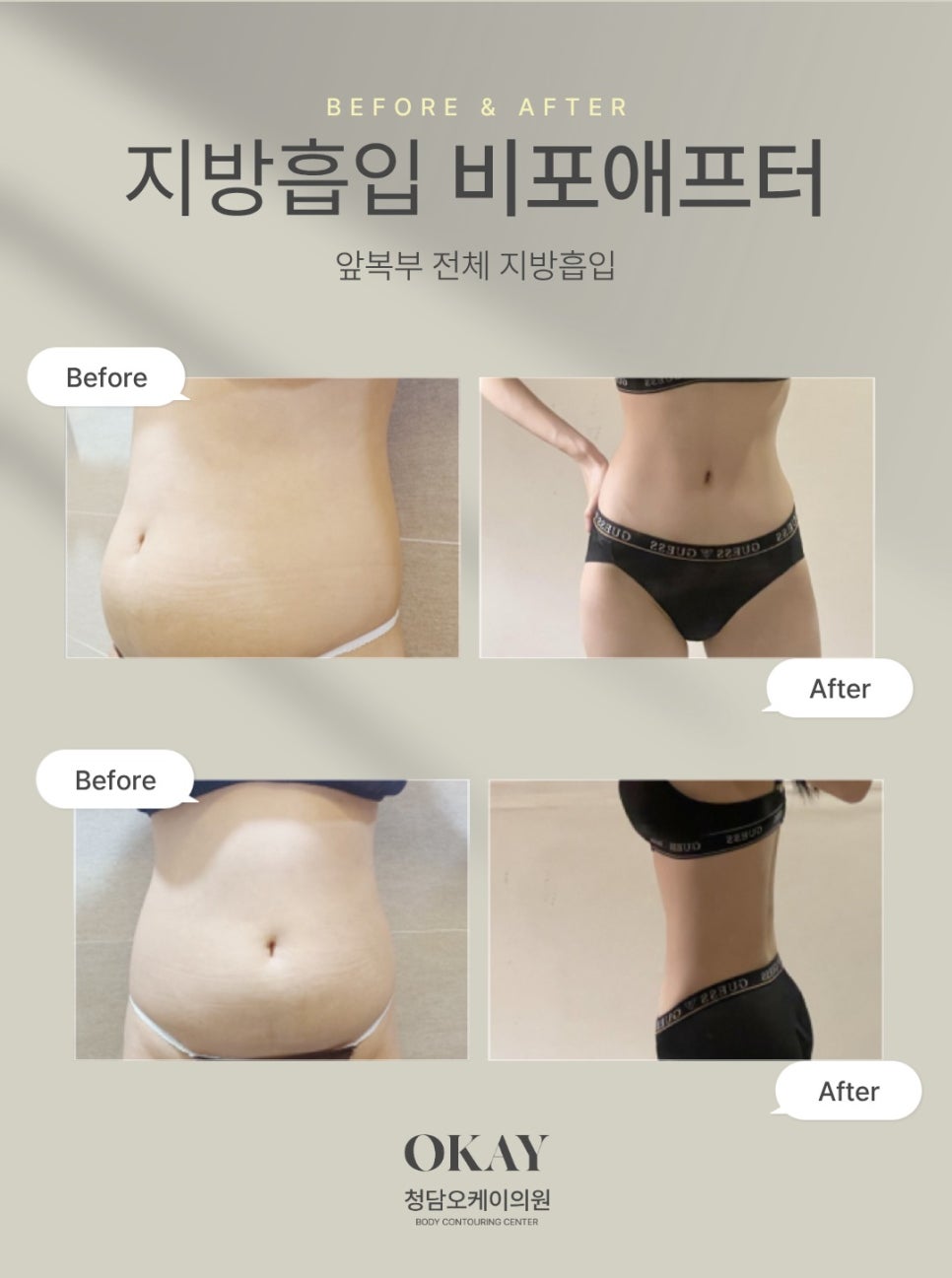 연예인지방흡입, 날씬함보다 중요한 디자인의 차이 관련 이미지 4