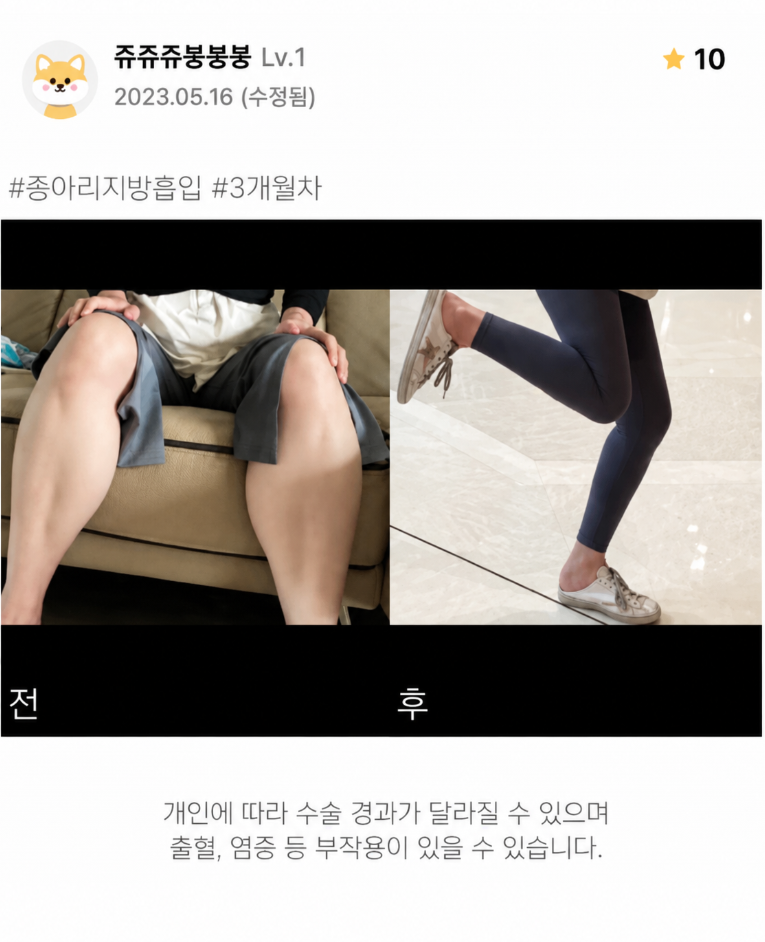 종아리지방흡입, 두꺼운 종아리 지방 때문인지 알 때문인지 구분해야 할까요? 관련 이미지 5