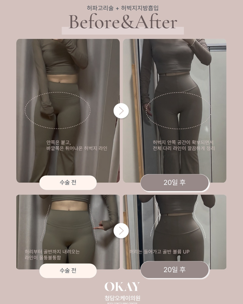 허벅지지방흡입, 효과가 만족도로 이어지는 이유 관련 이미지 6