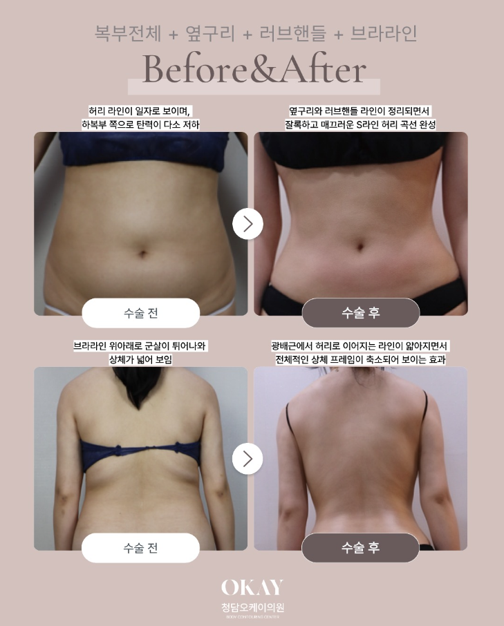 지방흡입후관리 방법 제대로 안 하면 생기는 문제, 붓기&middot;바본&middot;유착 관리 기준 정리 관련 이미지 6