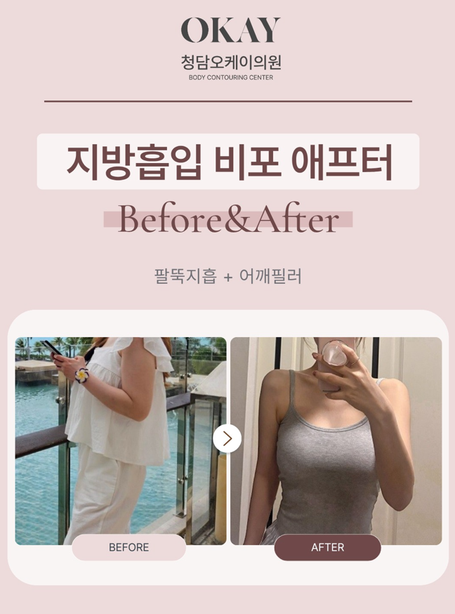 어깨필러 후기, 예쁜 직각어깨는 이렇게 만들어집니다 관련 이미지 7