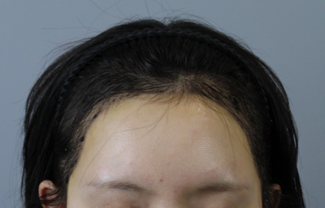절개모발이식 회복기간 얼마나 걸릴까? 통증&middot;비용&middot;후기&middot;샴푸 시기까지 정리 관련 이미지 7