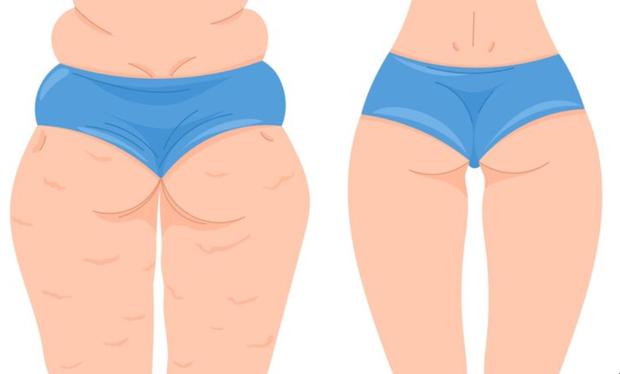 Thigh Liposuction Aftercare: Commute, Compression Garments, and Scars — A Realistic Look at Recovery by Period image 8