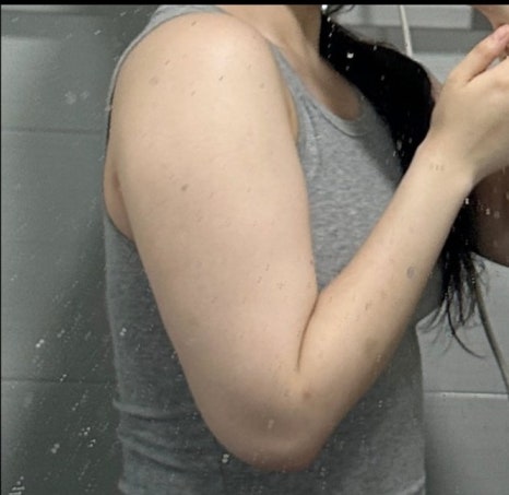 Arm Liposuction Review, How Long Do Swelling and Pain Last? Explanation of Recovery Criteria image 7
