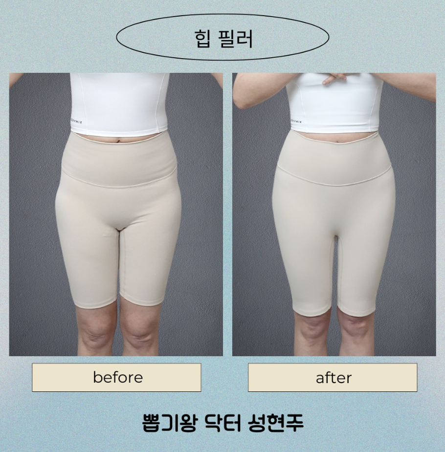 골반지방이식 vs 골반필러, 내 체형에 맞는 선택 기준 총정리 관련 이미지 8