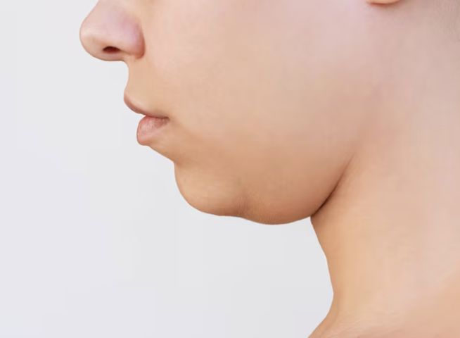 턱지방흡입, 살은 안 쪘는데 이중턱만 고민이라면 관련 이미지 6