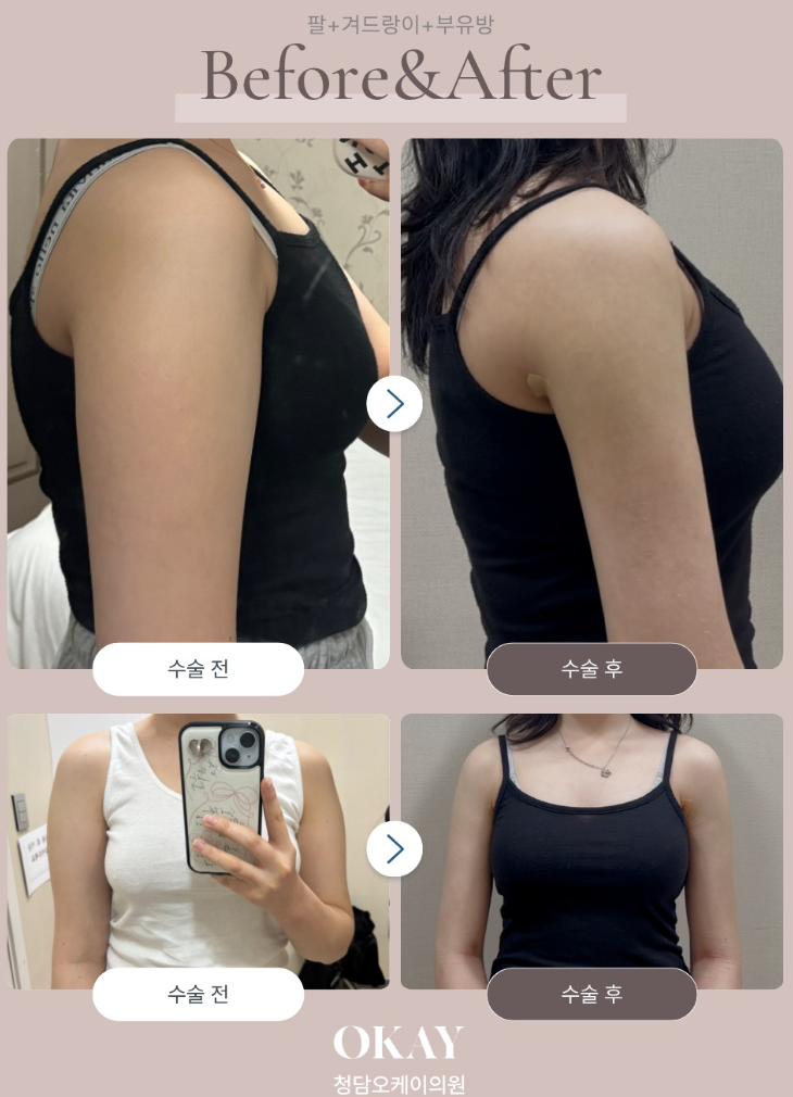 상체지방흡입, 팔뚝·등·옆구리까지 같이 해야 할까요? 관련 이미지 9
