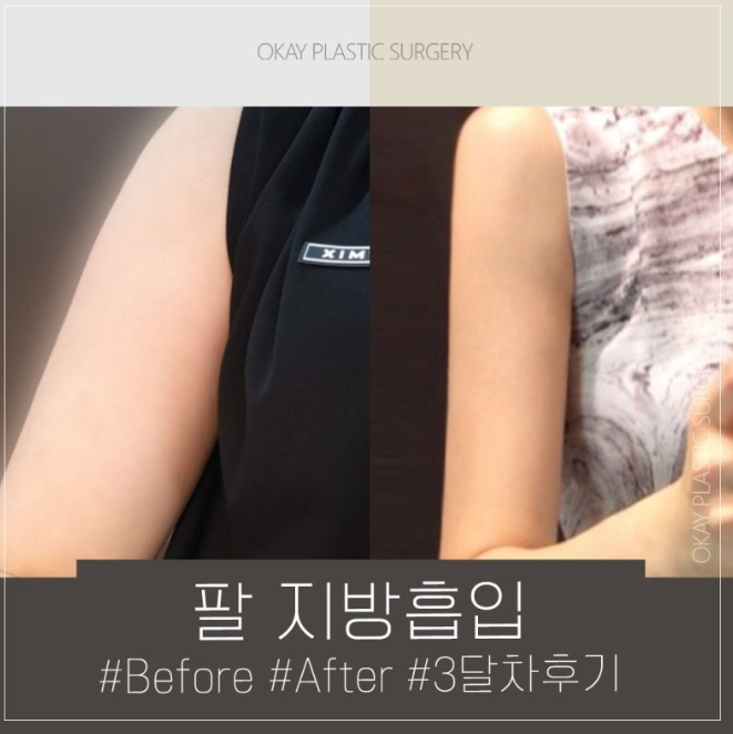 From 2 Weeks to 3 Months After Arm Liposuction: How Does the Arm Contour Change? image 8