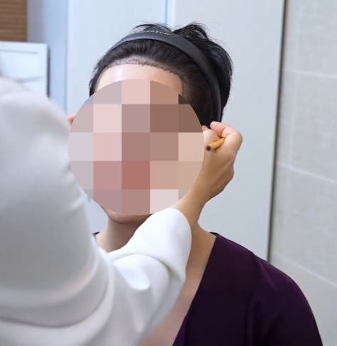 강남 여자앞머리모발이식 생착률 얼마나 될까? 몇모·디자인·통증·가격 정리 관련 이미지 8