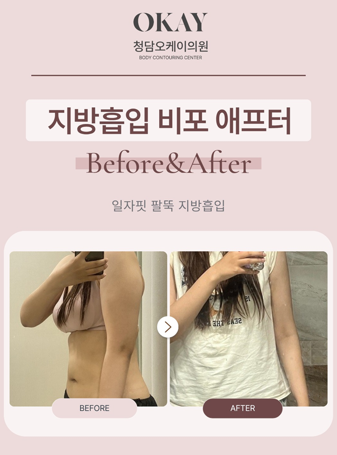 압구정로데오 성형외과, 지방흡입은 양보다 디자인입니다 관련 이미지 4