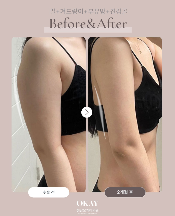 Recovery Process After Arm Liposuction: A Summary of Swelling, Bruising, and Compression Garment Wear Periods Based on Post-Op Reviews image 10