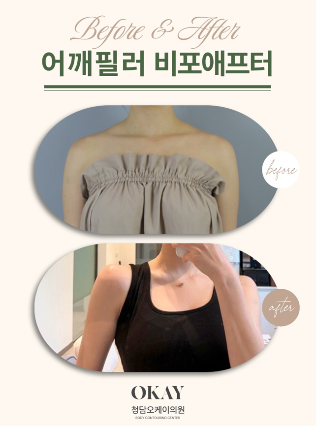 제니어깨 필러, 직각어깨 만들려면 어디에 채워야 할까요? 관련 이미지 4