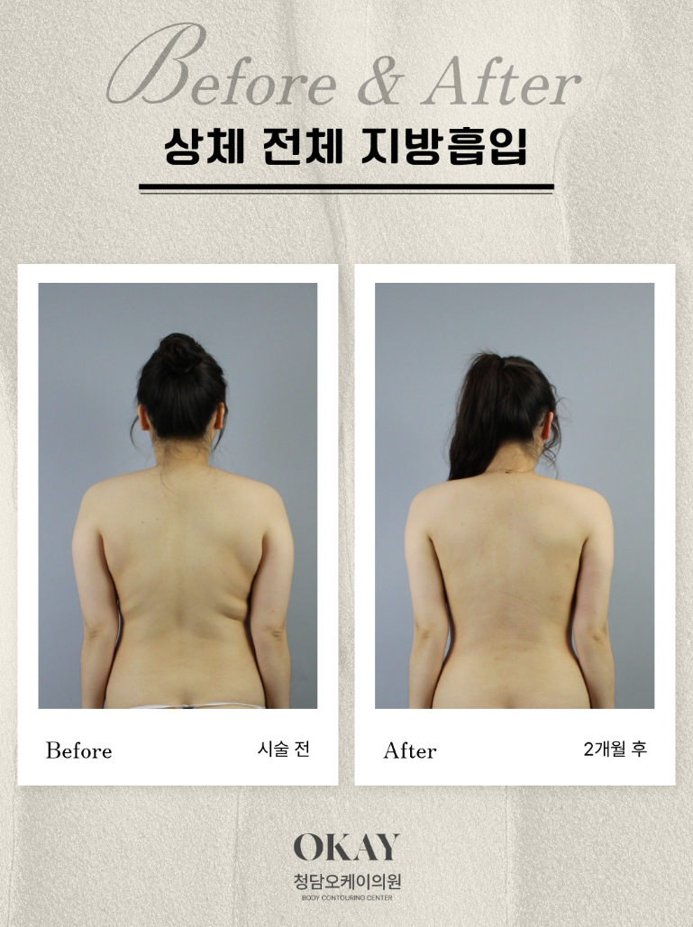 상체지방흡입, 팔뚝·등·옆구리까지 같이 해야 할까요? 관련 이미지 6