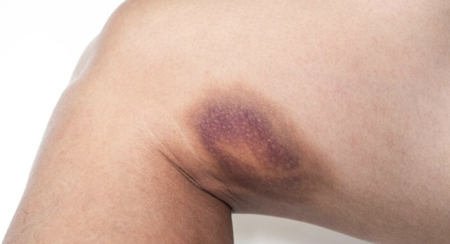 대용량 지방흡입, 일반 지방흡입과 무엇이 다를까? 관련 이미지 9