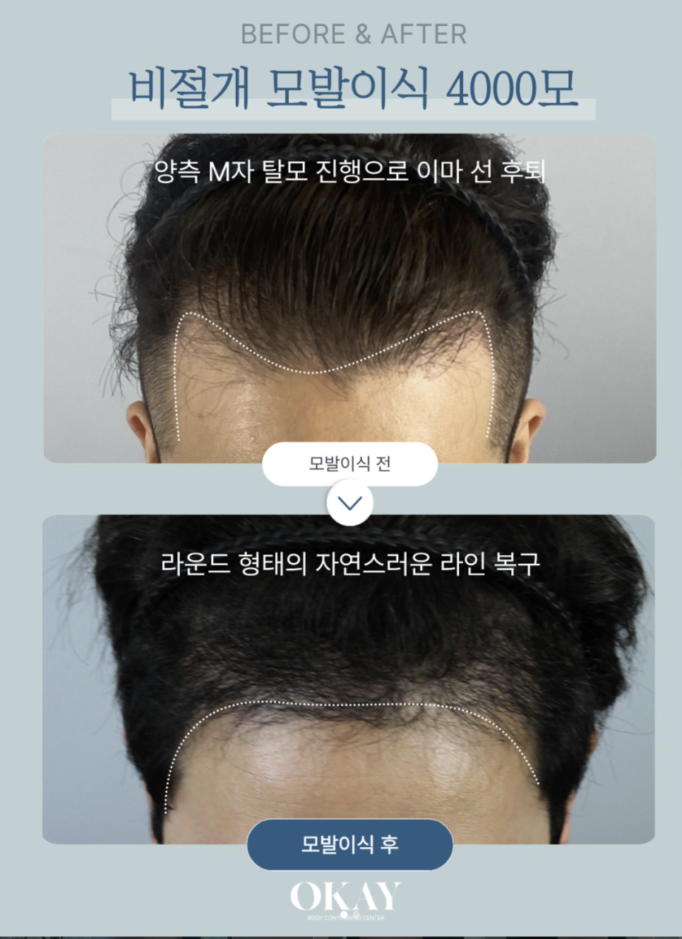 정수리모발이식, 얼마나 지속될까? 먼저 확인해야 할 관련 이미지 5