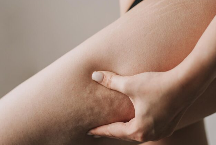 지방흡입재수술, 울퉁불퉁한 라인 다시 매끈해질 수 있을까? 관련 이미지 3