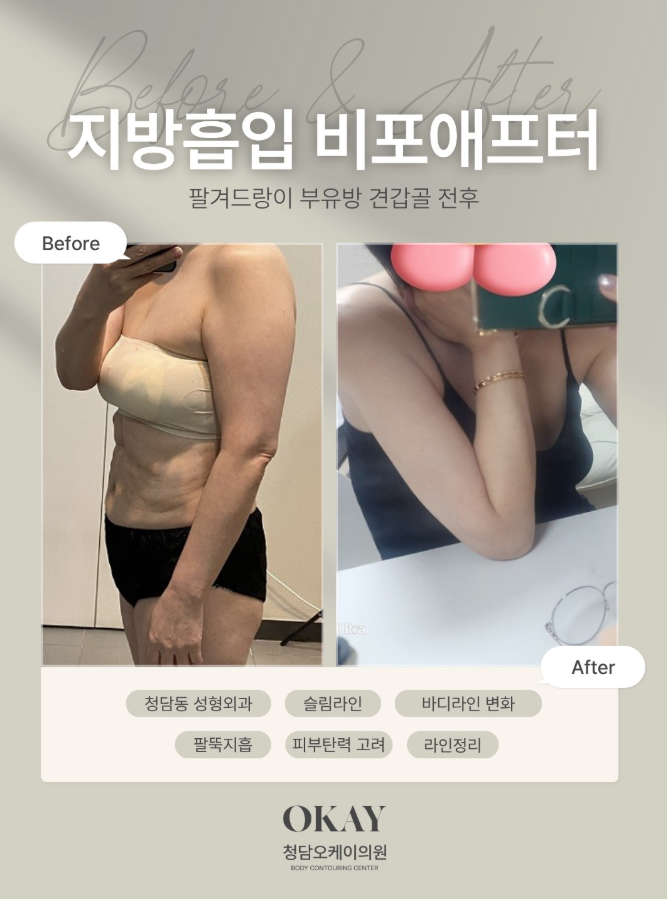 겨드랑이부유방 제거, 지방흡입으로 해결할 수 있을까요? 관련 이미지 8