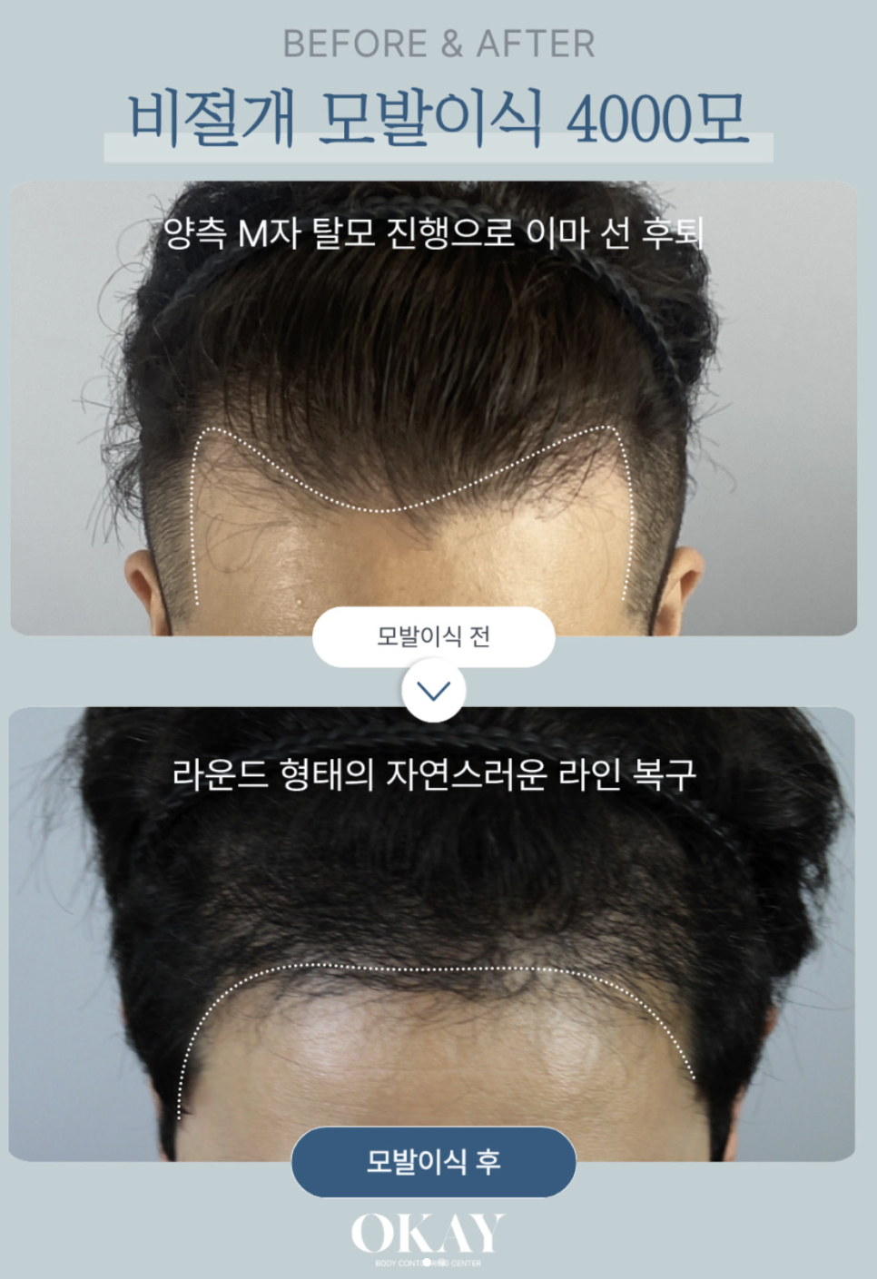 강남탈모병원, 언제부터 모발이식을 고려해야 할까요? 관련 이미지 2