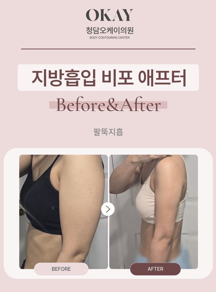 Forearm Liposuction: How Design Differs by Body Type image 7