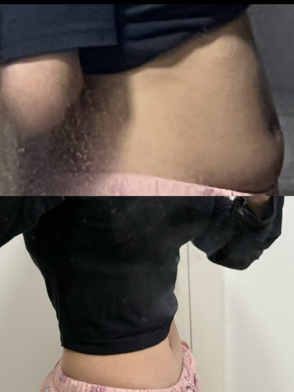 대용량 지방흡입 라인 제대로 살리려면 흡입 범위가 중요한 이유, 원장이 직접 알려드립니다. 관련 이미지 10