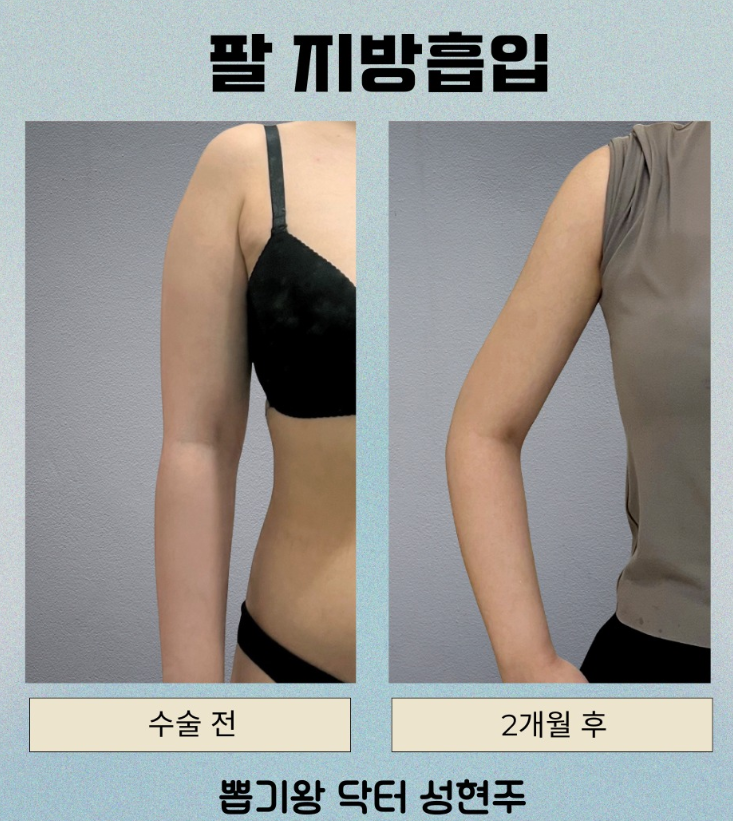 부유방수술비용, 지방흡입만 하면 더 저렴할까요? 관련 이미지 9