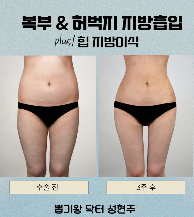 압구정 다이어트, 지방흡입 후기로 보는 부위별 라인 변화 관련 이미지 8