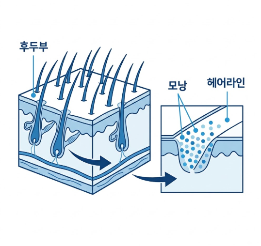 헤어라인모발이식, 이마만 채우면 끝일까요? 관련 이미지 10