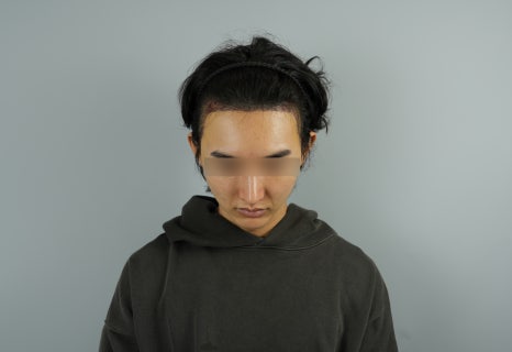 남자헤어라인모발이식, 부자연스러워 보이는 이유를 설명드립니다 관련 이미지 7