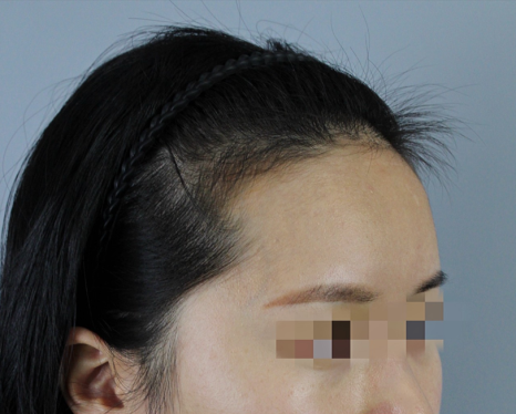 Female Crown Hair Transplantation: Explaining Why Results and Graft Survival Rates Differ image 5