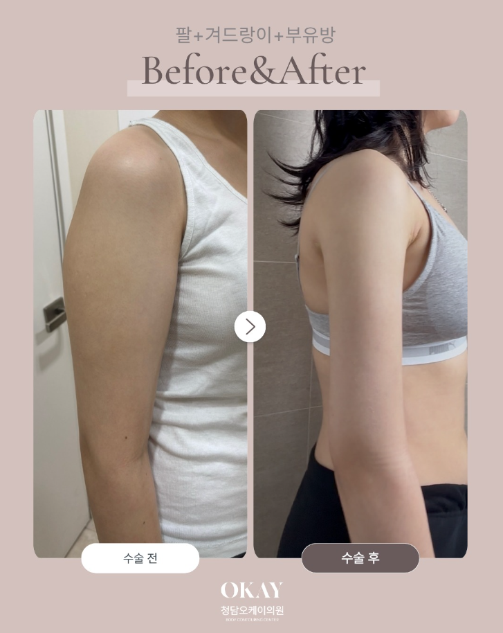 팔지흡 후기 당일부터 일주일차까지, 붓기&middot;통증 회복 과정 현실적으로 정리했습니다 관련 이미지 5