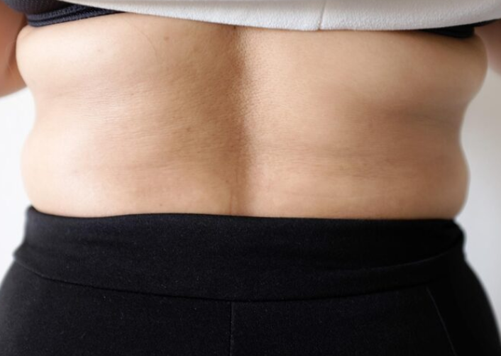 러브핸들지방흡입, 옆구리살만 빼도 허리라인이 달라질까요? 관련 이미지 3