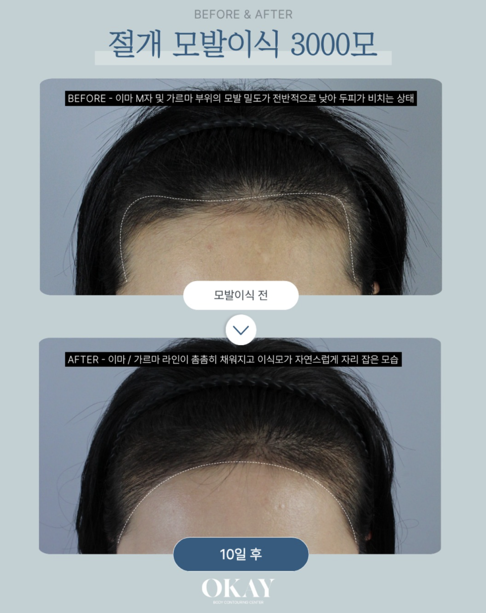 정수리모발이식, 얼마나 지속될까? 먼저 확인해야 할 관련 이미지 4
