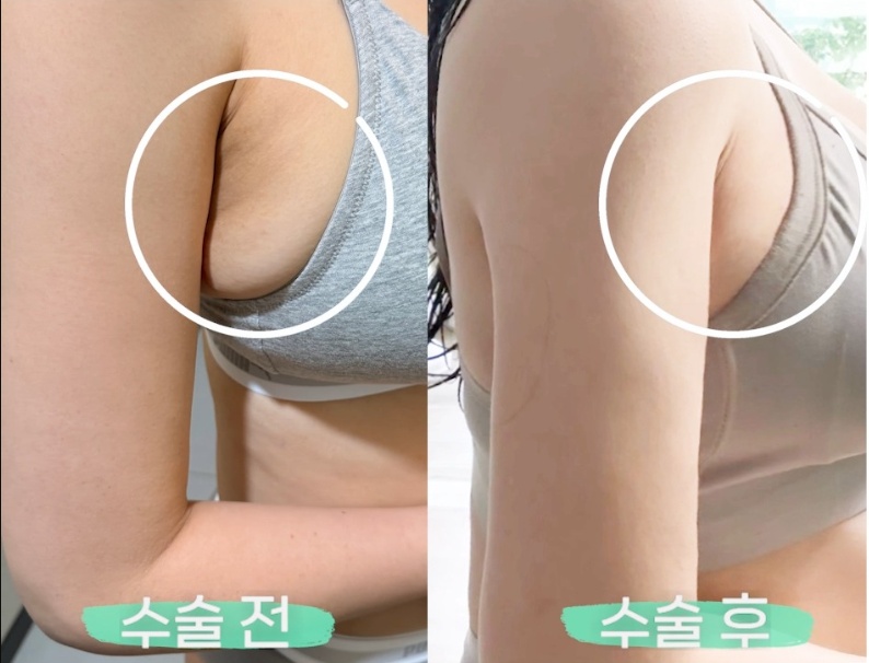 여자 부유방 vs 남자 부유방, 지방 vs 유선 차이부터 확인하세요 관련 이미지 5
