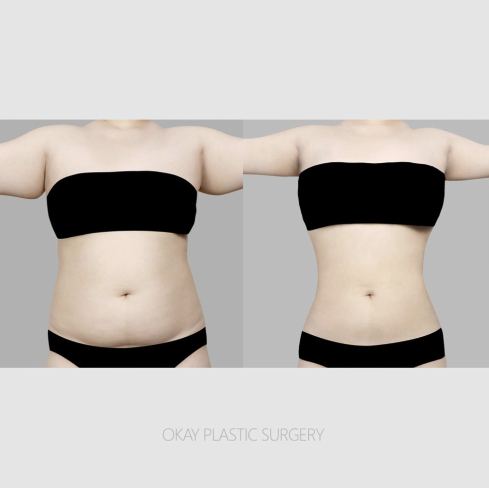Liposuction Surgery Methods: Things Not Often Covered in Reviews image 2