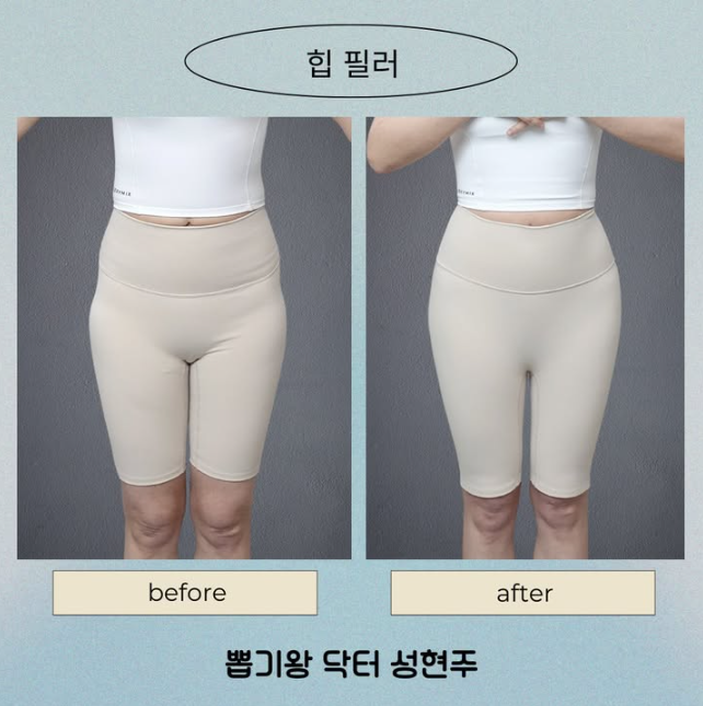 How Long Does Pelvic Filler Last? Body Shape Changes and Effects Explained image 7