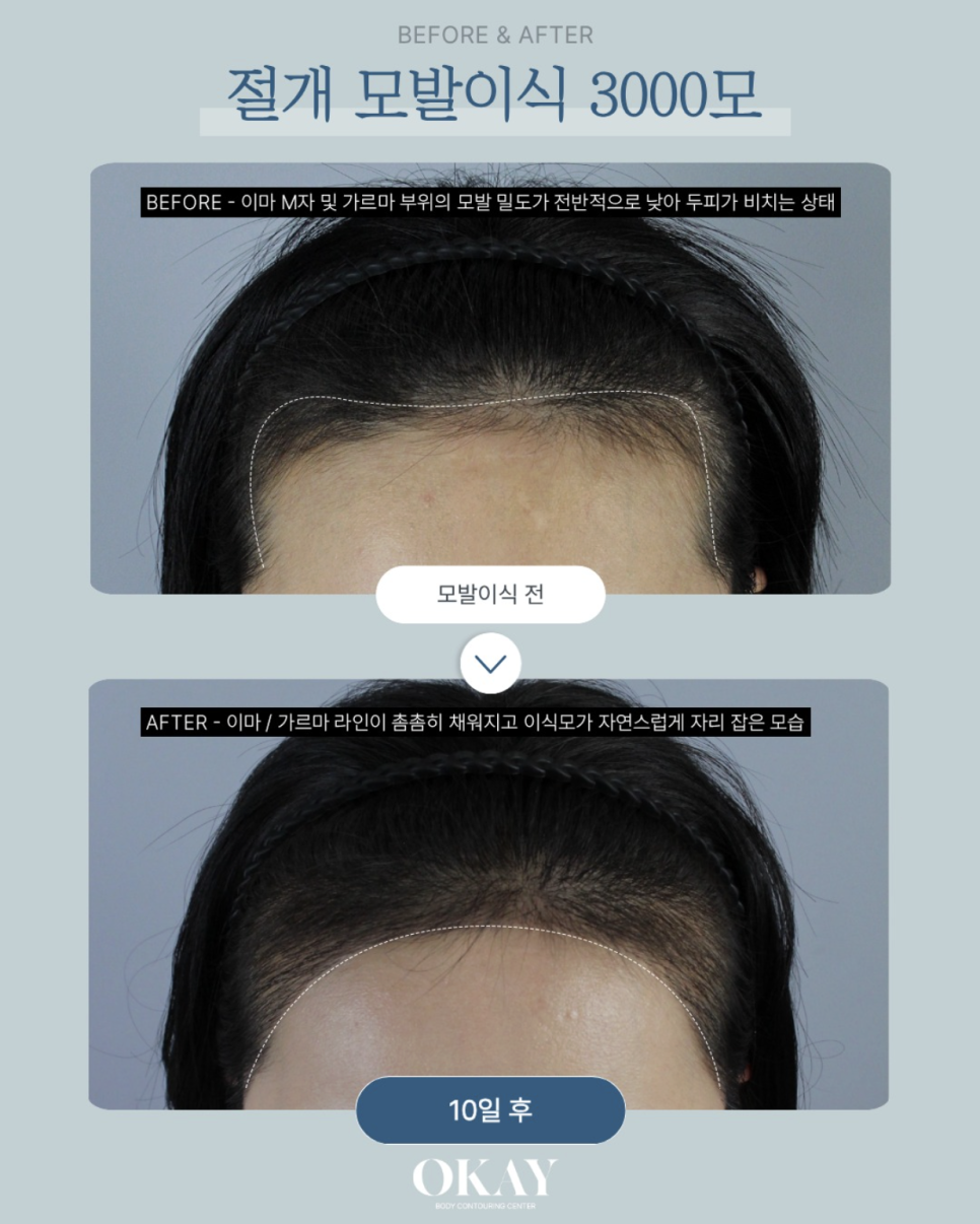 헤어라인모발이식 후 자연스러움을 결정하는 3가지 기준 관련 이미지 9