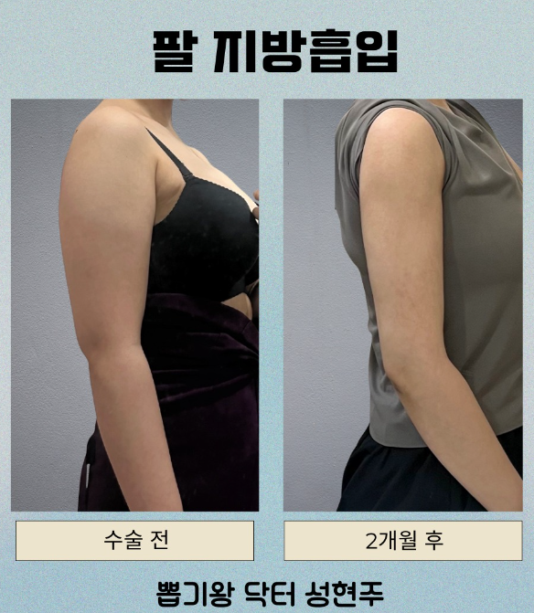강남지방흡입병원, 체중보다 ‘라인’을 먼저 봐야 하는 이유 관련 이미지 6