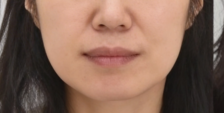 How Much Difference Does Facial Autologous Fat Grafting Make Before and After? A Summary of Duration, Swelling, and Survival Rate image 2