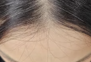 여자모발이식잘하는곳, 헤어라인 모발이식 병원 선택할 때 꼭 봐야 할 기준 관련 이미지 5