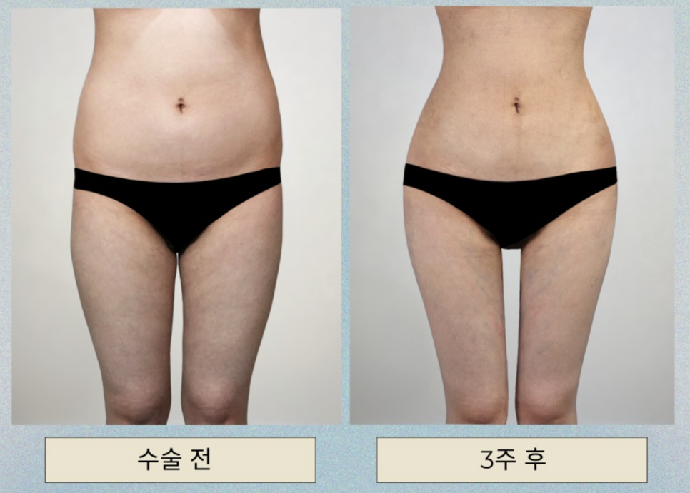 What Is Waist–Hip Contouring Surgery? Why Design the Waist and Pelvis Together image 2