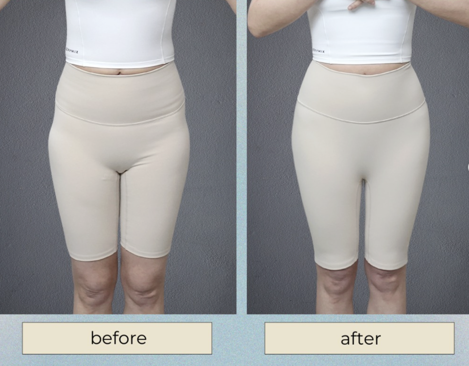 Pelvic Filler Duration: 1 Year? 3 Years? Why the Difference Is Greater Than You Might Expect image 10