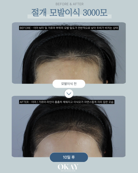 M자헤어라인모발이식 후 바로 출근 가능할까? 통증부터 회복기간까지 꼭 알아야 할 정보 총정리 관련 이미지 10
