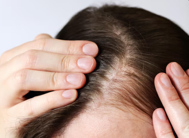 Non-Incisional Hair Transplantation: What to Check for Natural-Looking Results image 7