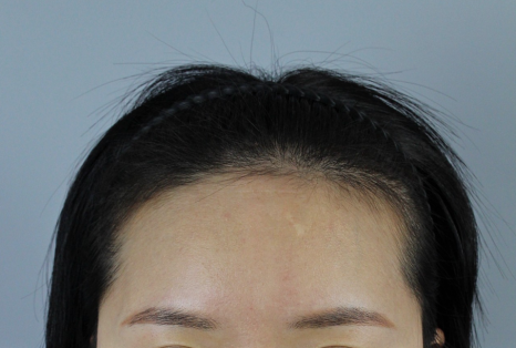 Why Results End Up Bad After Finding a ‘Hair Transplant Hotspot’ Clinic in Seoul: This Is Where It Comes Down to the Details image 8
