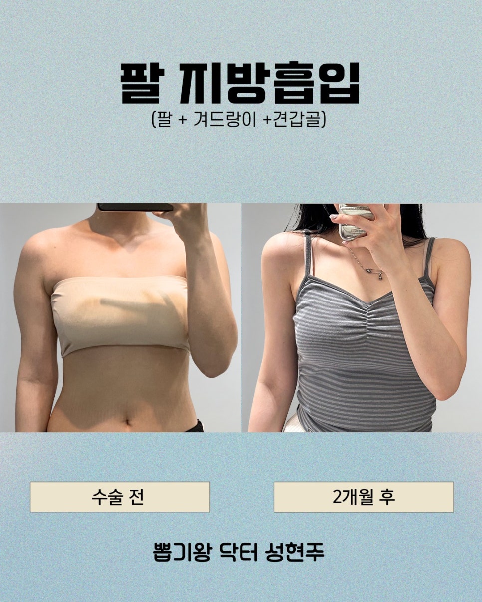 팔지방흡입, 내돈내산 후기보다 먼저 확인해야 하는 처짐·멍·회복기간 관련 이미지 6