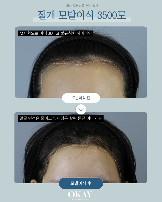 여성헤어라인모발이식, 단순 채움이 아닌 &lsquo;라인 설계&rsquo;가 중요합니다 관련 이미지 6