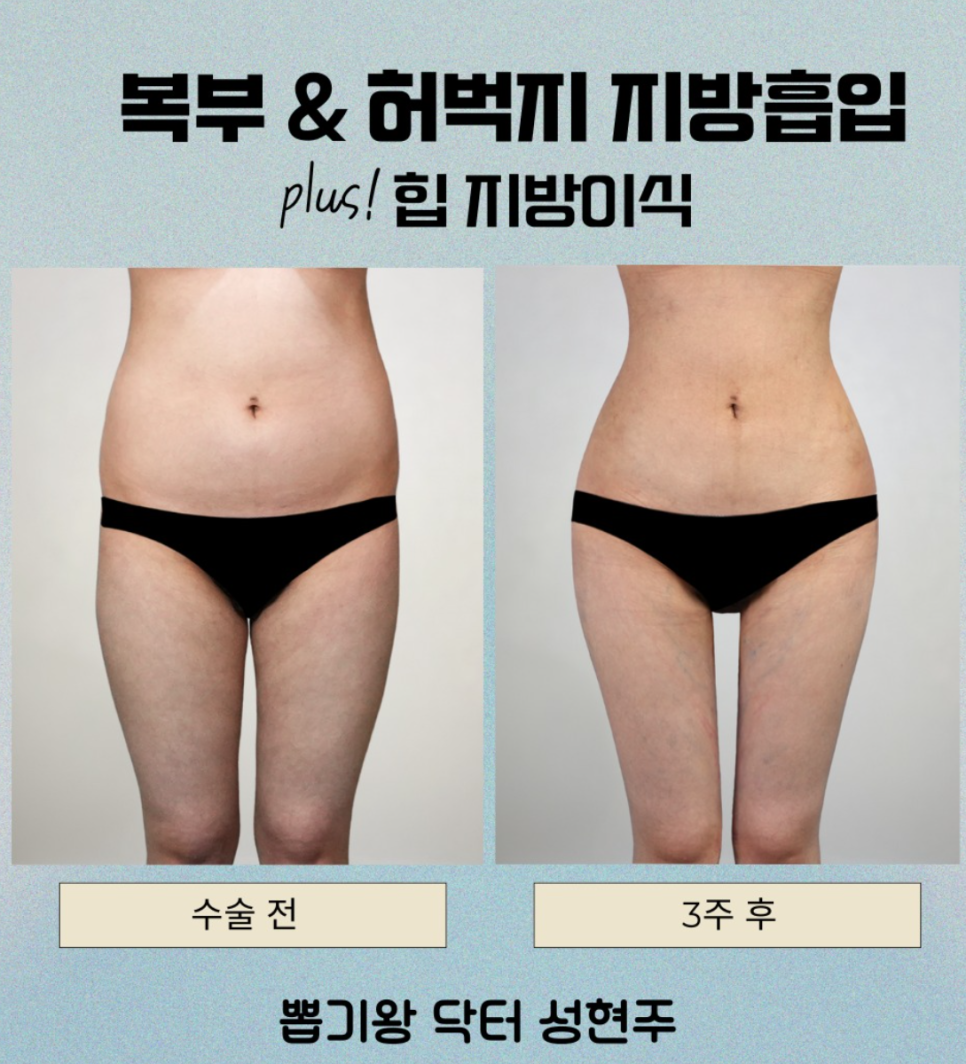 뱃살지흡 후기, 아랫배부터 옆구리까지 어디까지 달라질까요? 관련 이미지 10