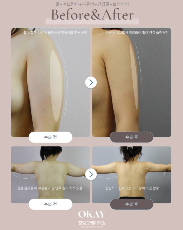 팔뚝지방흡입수술비용, 겨드랑이·부유방까지 하면 얼마나 달라질까? 관련 이미지 5