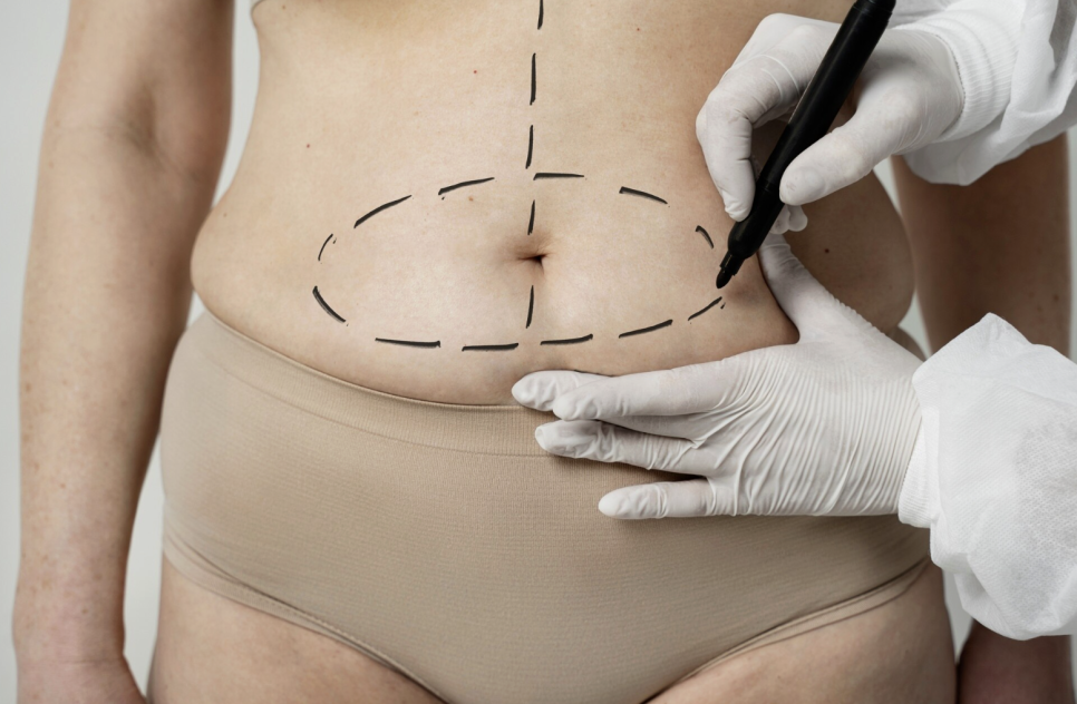 If You’re Looking for a Clinic Skilled in Revision Liposuction, Why You Should Never Simply Undergo Liposuction Again image 6